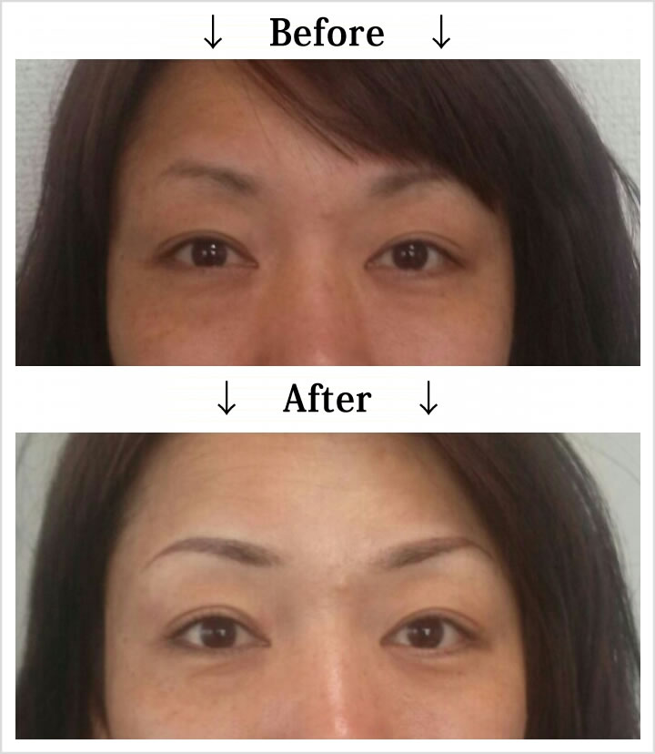 マイクロピグメンテーション・Before_After2