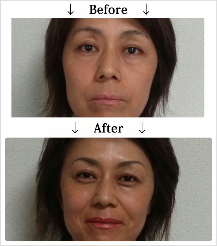 マイクロピグメンテーション・Before_After2