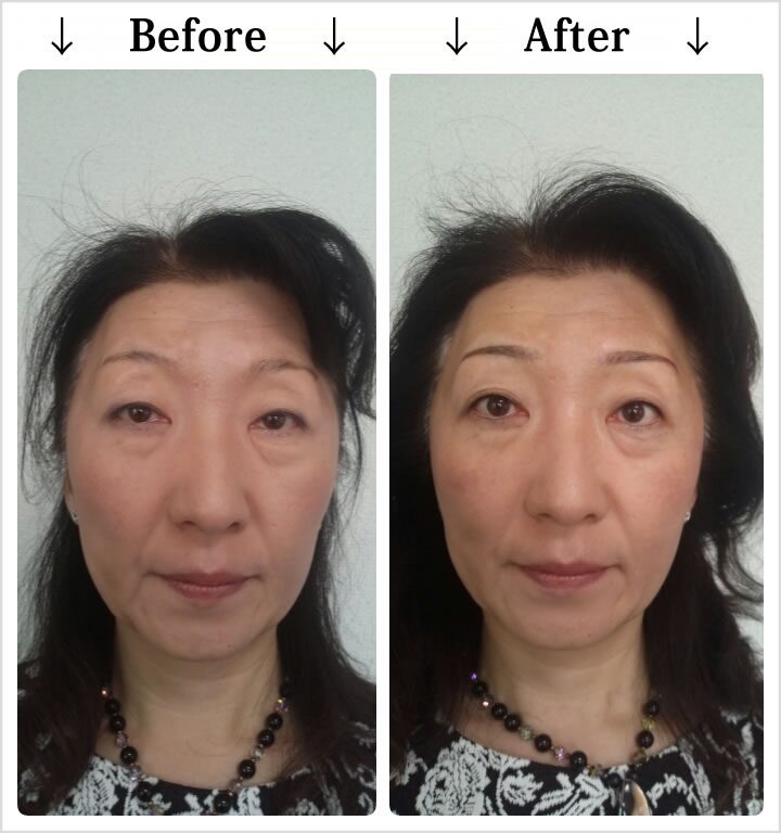 マイクロピグメンテーション・Before_After1