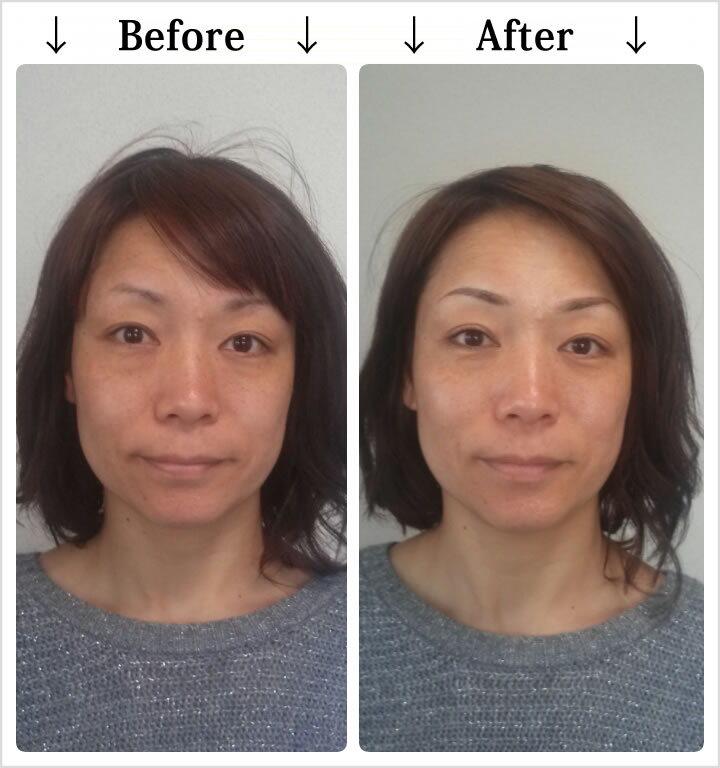 マイクロピグメンテーション・Before_After1