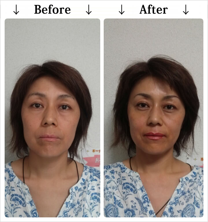 マイクロピグメンテーション・Before_After1